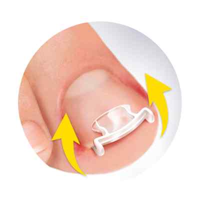 Scholl Eingewachsene Zehennägel Clips & Spray bei apo-discounter.de bestellen