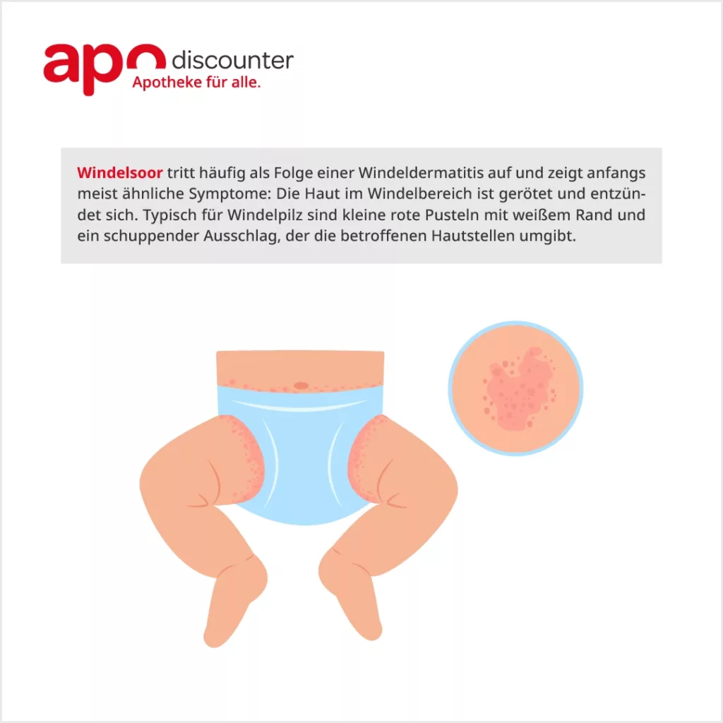 Infografik Windeldermatitis