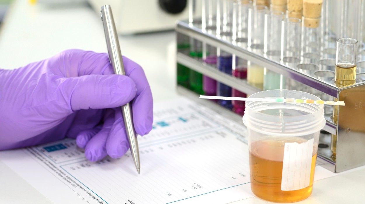 Urinprobe mit Teststreifen im Labor zur Diagnose einer Blasenentzündung beim Mann