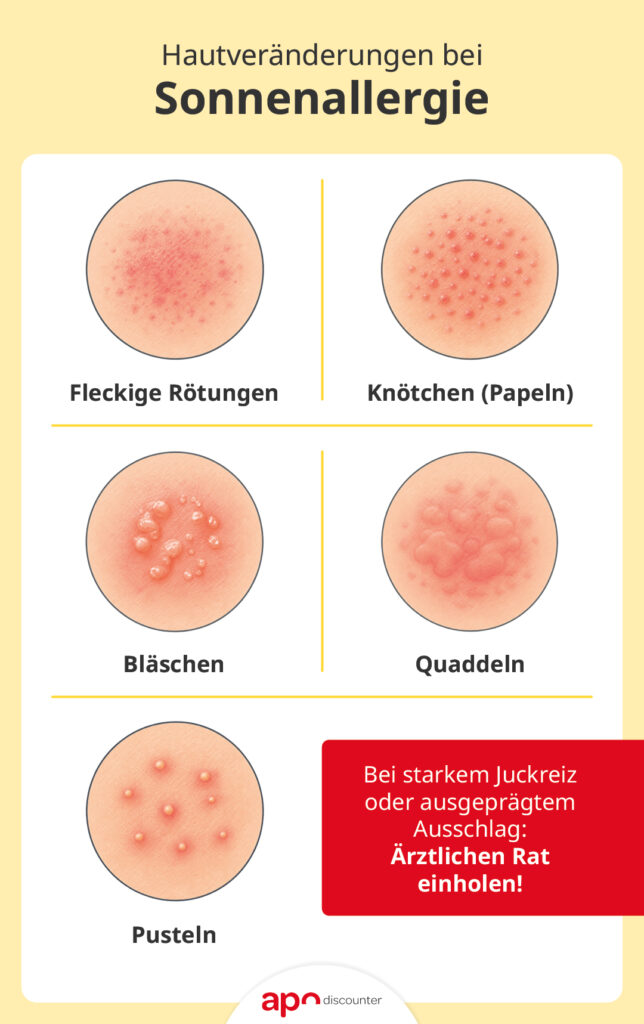 Sonnenallergie: Bilder der Hautveränderungen