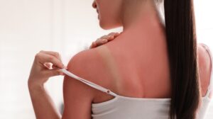 Sonnenbrand auf Schulter