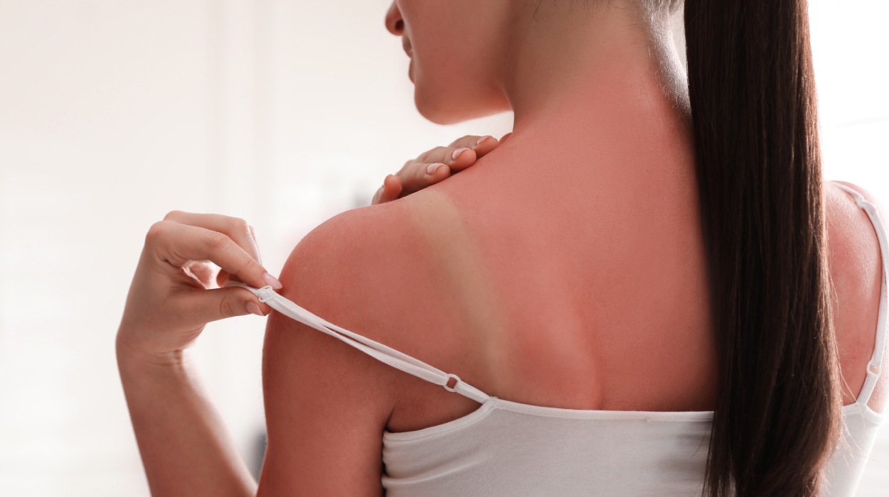 Sonnenbrand auf Schulter